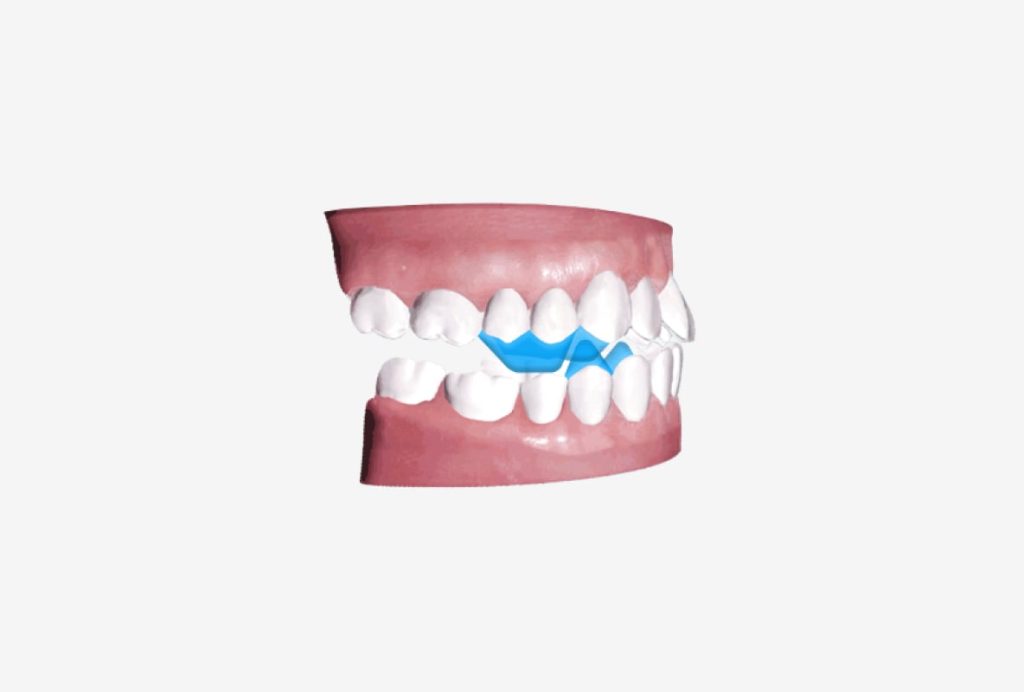 A6 Mandibular Advancement | Angel Aligner